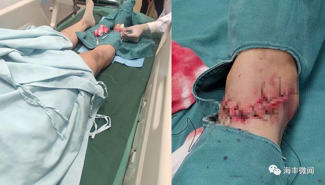 云南玉昆球员张祥硕被撞后出现眩晕伤势无大碍的简单介绍